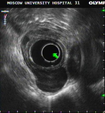 Рис.1 Эндосонография подслизистой опухоли пищевода