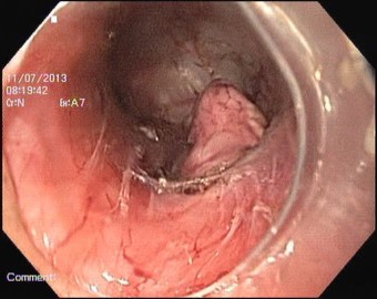 Рис. 2 Интраорганная часть опухоли, доступная осмотру через тоннель в подслизистом слое пищевода. 