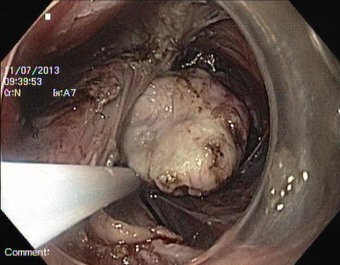 Рис. 3 Удаление части опухоли при помощи полипэктомической петли через двойной (подслизистый и мышечный) тоннель.