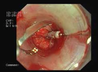 Рис. 9. Эндоскопическое клипирвоание дефекта пищевода