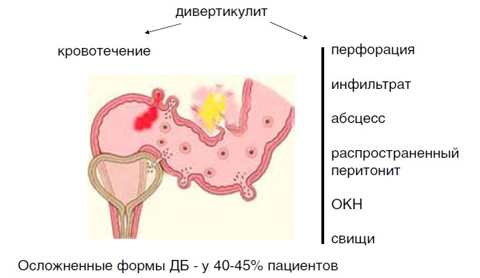 Рис. 3. Осложнения дивертикулярной болезни