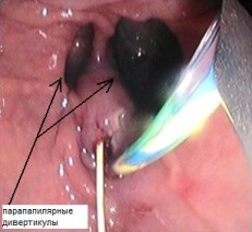Рис. 1. Парапапилярные дивертикулы. ЭПСТ по проводнику, проведенному антеградно