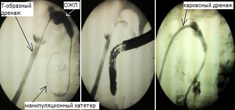 Рис. 2. Поэтапное комбинированное восстановление проходимости ОЖП в области стриктуры последнего через мигрировавший из ОЖП Т-образный дренаж