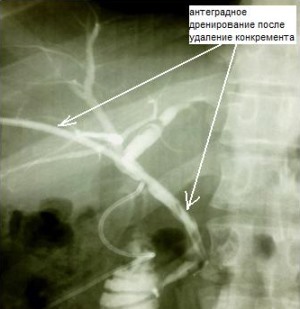 Рис. 6. Фистулохолангиография после антеградной литоэкстракции