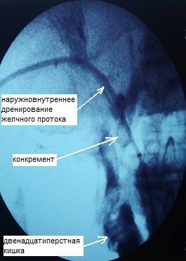 Рис. 8. Антеградное наружновнутреннее дренирование желчных протоков. При контрастировании затека КВ не выявлено.