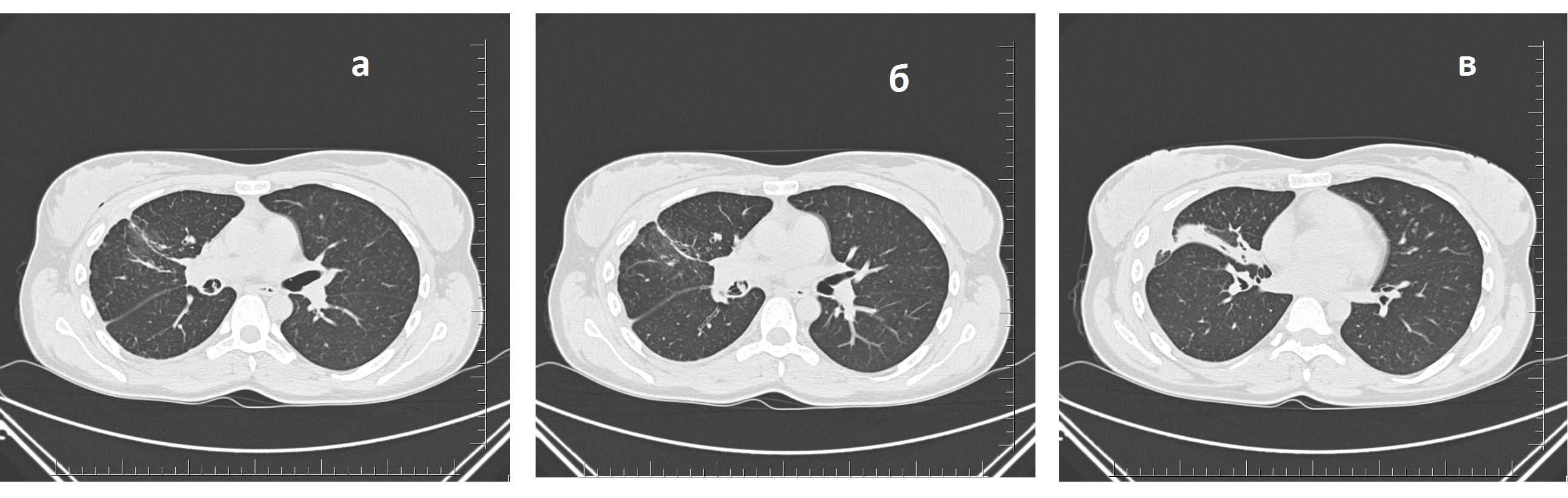 Рис 4 а б в Р КТ органов грудной клетки через месяц после установки бронхоблокатора Купирование подкож ной эмфиземы пневмогидроторакса участок фиброза легочной ткани в месте деструкции  