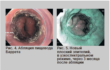 Пищевод Баррета