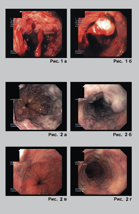 Опыт эндоскопического лигирования варикозно-расширенных вен пищевода у больных с портальной гипертензией