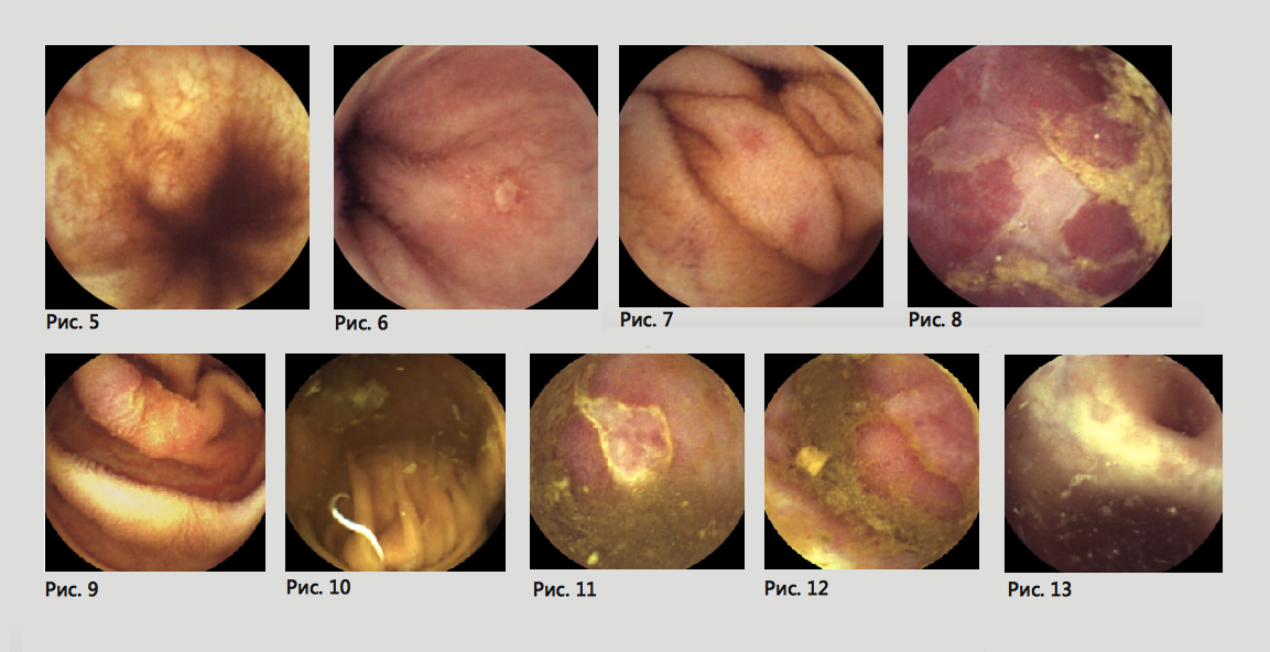 Cuanto tiempo dura una endoscopia con sedación